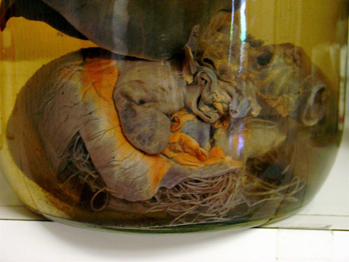 Photo of Dog Heartworm (Dirofilaria immitis)
